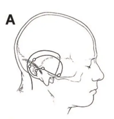 巨大岩斜区脑膜瘤,幕上幕下联合入路全切手术图解——INC国际大咖之Couldwell教授