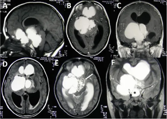 【INC国际大咖研究成果】造釉细胞型颅咽管瘤：治疗策略的演变