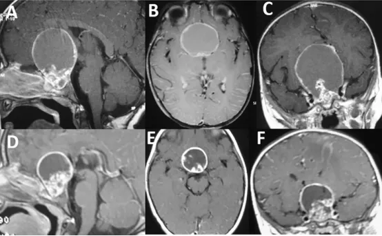 5岁女童颅咽管瘤（AC）的T1加权MRI扫描显示