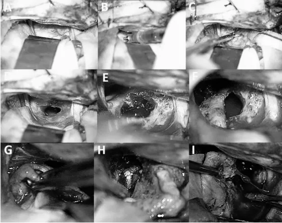 图2同一病例的术中视图