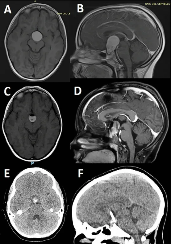 7岁女童的T1加权MRI平扫（图A）及钆对比剂增强扫描（图B）显示存在颅咽管瘤（AC）。增强后可见肿瘤实性部分强化，囊性成分呈典型表现。