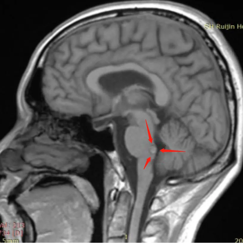 从 “走不稳” 到 “打羽毛球”，脑干海绵状血管瘤患者 4 年重生之路！