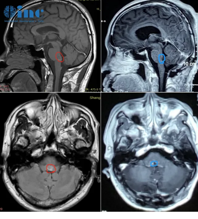 脑干海绵状血管瘤影像