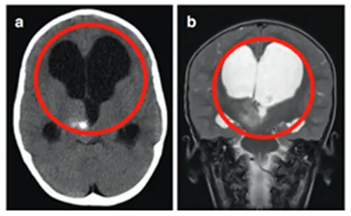 胶质瘤手术案例
