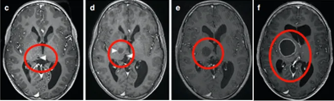 胶质瘤手术案例