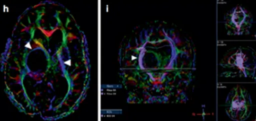 MRI显示囊性占位解除，脑室慢慢恢复正常。
