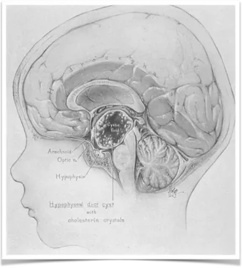 孩子差点被颅咽管瘤毁了……为何这个脑瘤需要用一生去“治愈”？