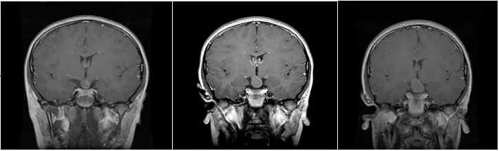 1999年7月因头痛查出颅咽管瘤，并在2000年1月及4月的复查中发现肿瘤不断生长。