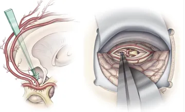 治疗：手术是主要手段