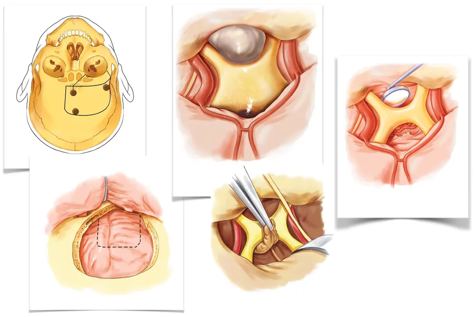 治疗：手术是主要手段
