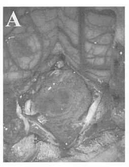 （A）硬脑膜切开后可见向下延伸至C1水平的大型肿瘤；