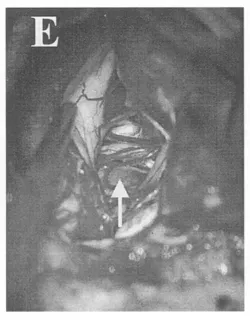 （E）小脑延髓外侧池内结构完整，箭头指示右侧椎动脉；