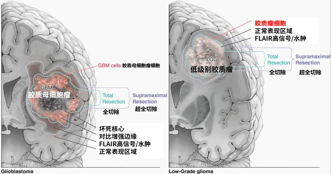 图2.图示高级别（a）和低级别（b）胶质瘤的超全切除定义。