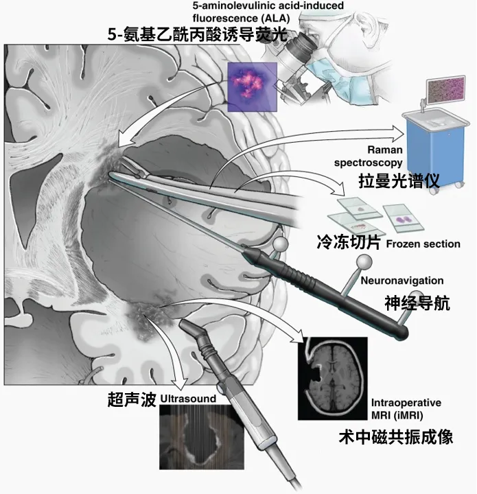 图4.术中识别肿瘤边缘的方法。