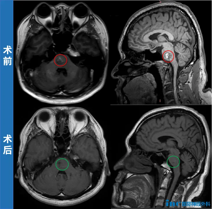 脑干海绵状血管瘤手术后还会卷土重来吗？3个“没想到”扭转结局​，他至今无复发