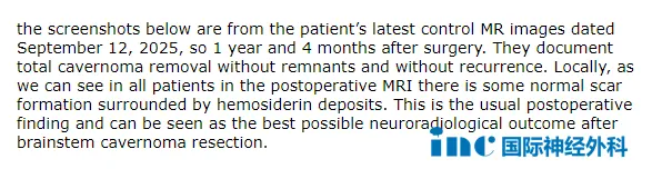脑干海绵状血管瘤2次出血