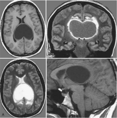 孕期查出脑瘤的3大难题：检查伤胎吗？能手术吗？宝宝能保住吗？​