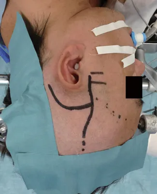 手术入路皮肤切口