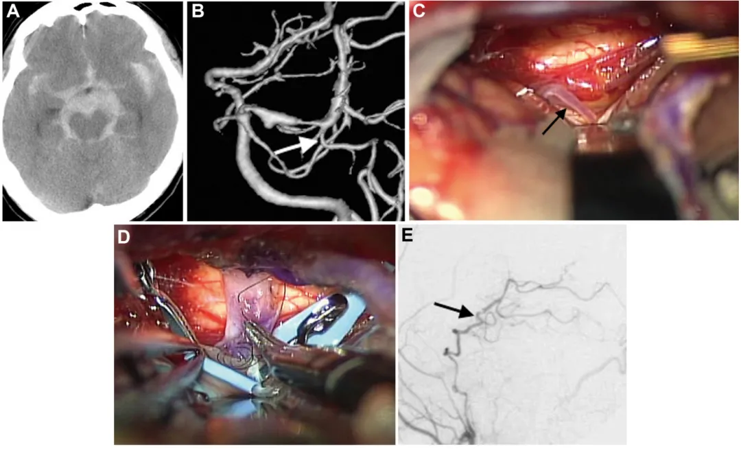 病例2：术前影像（A、B）、术中照片（C、D）及术后血管造影（E）