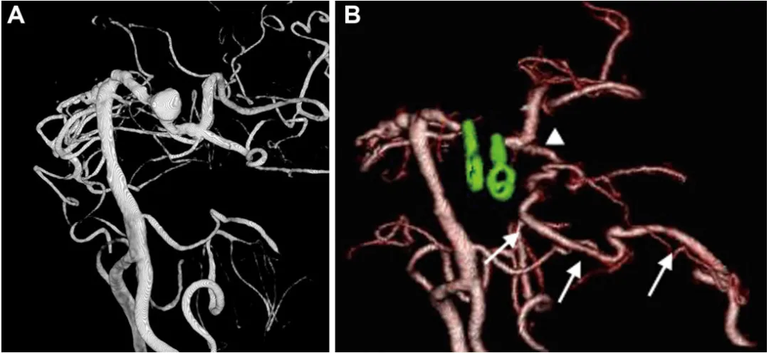 病例3：术前（A）及术后（B）影像