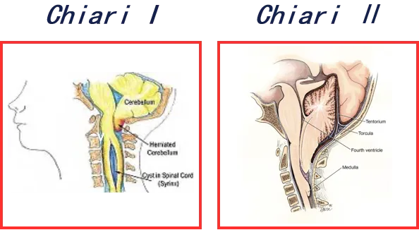 ▷Chiari I型▷Chiari II型