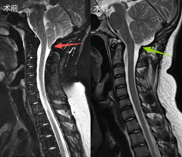 年轻运动员因头痛查出脑部畸形！为了重回赛场，他拼了！