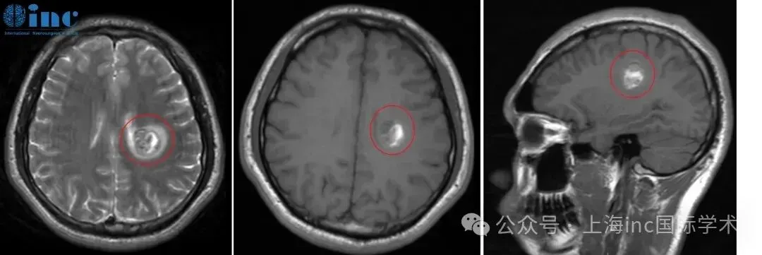 写字困难到急性出血，看INC国际巴教授如何为他安全全切大脑功能区海绵状血管瘤！