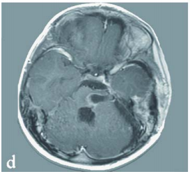3岁女儿急性脑出血被送上救护车,良性病变竟成“催命符”