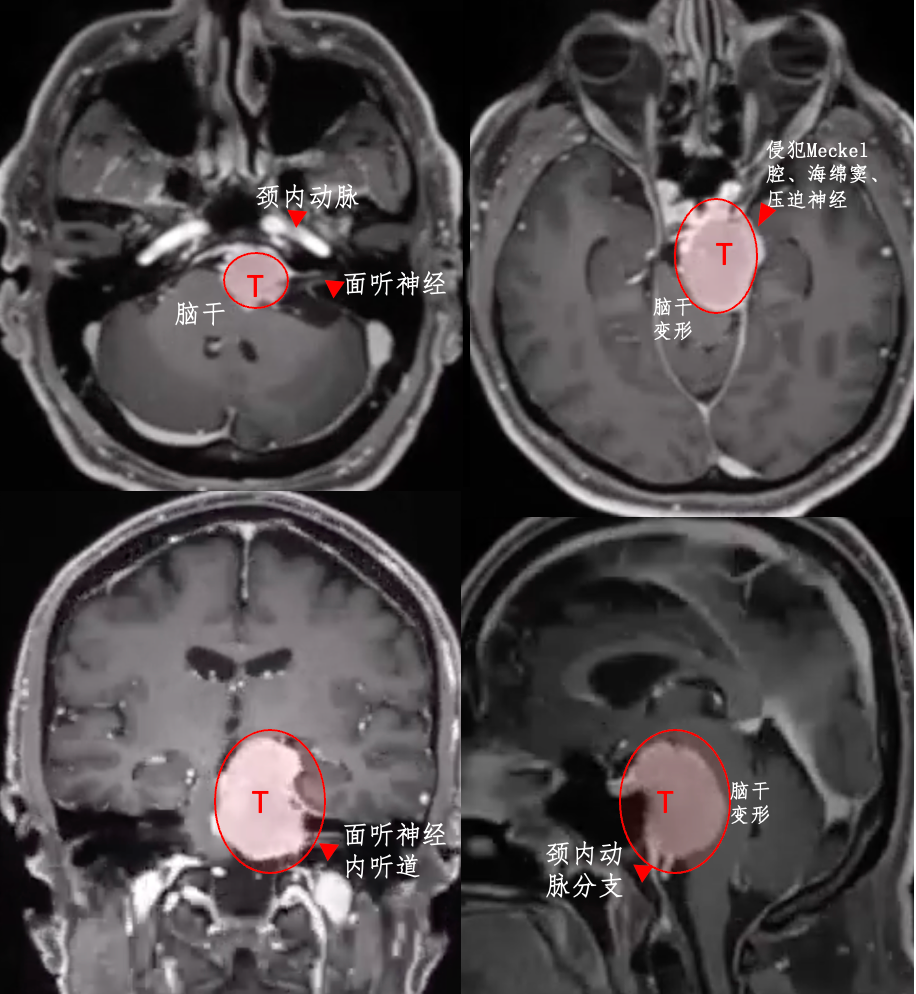 良性脑瘤能长多快