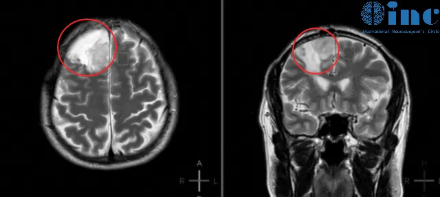二级胶质瘤术后4年复发恶化成三级巨大肿瘤