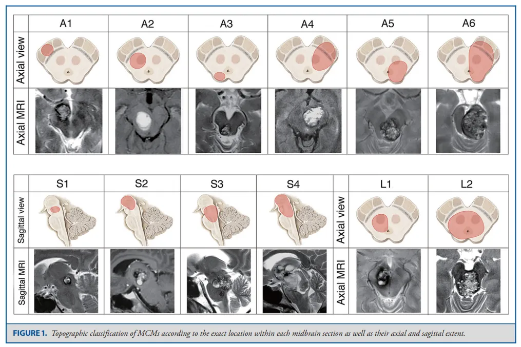 中脑海绵状血管瘤如何完整切除？