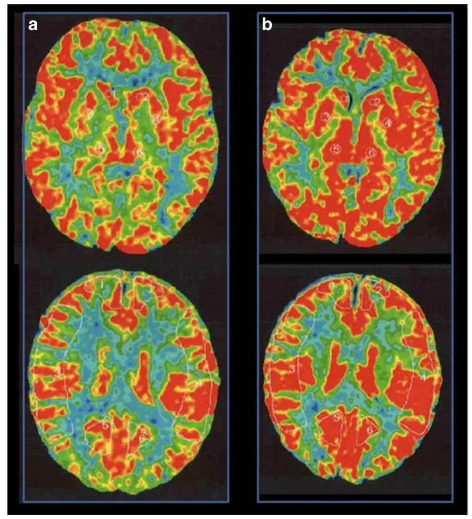 10岁女孩头痛背后藏危机：竟是儿童烟雾病早期信号？