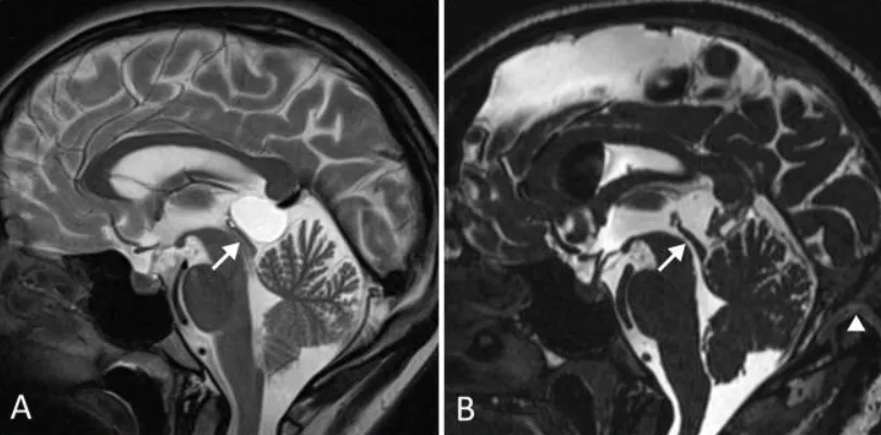 术前（A）及术后（B）