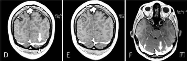 增强T1加权磁共振成像（冠状位D、E，轴位F）