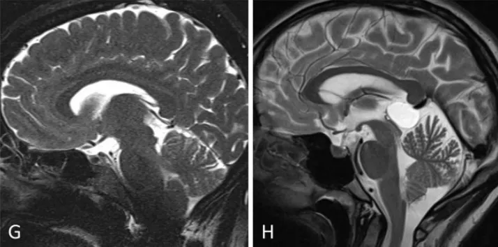 小脑幕倾斜度变异分析