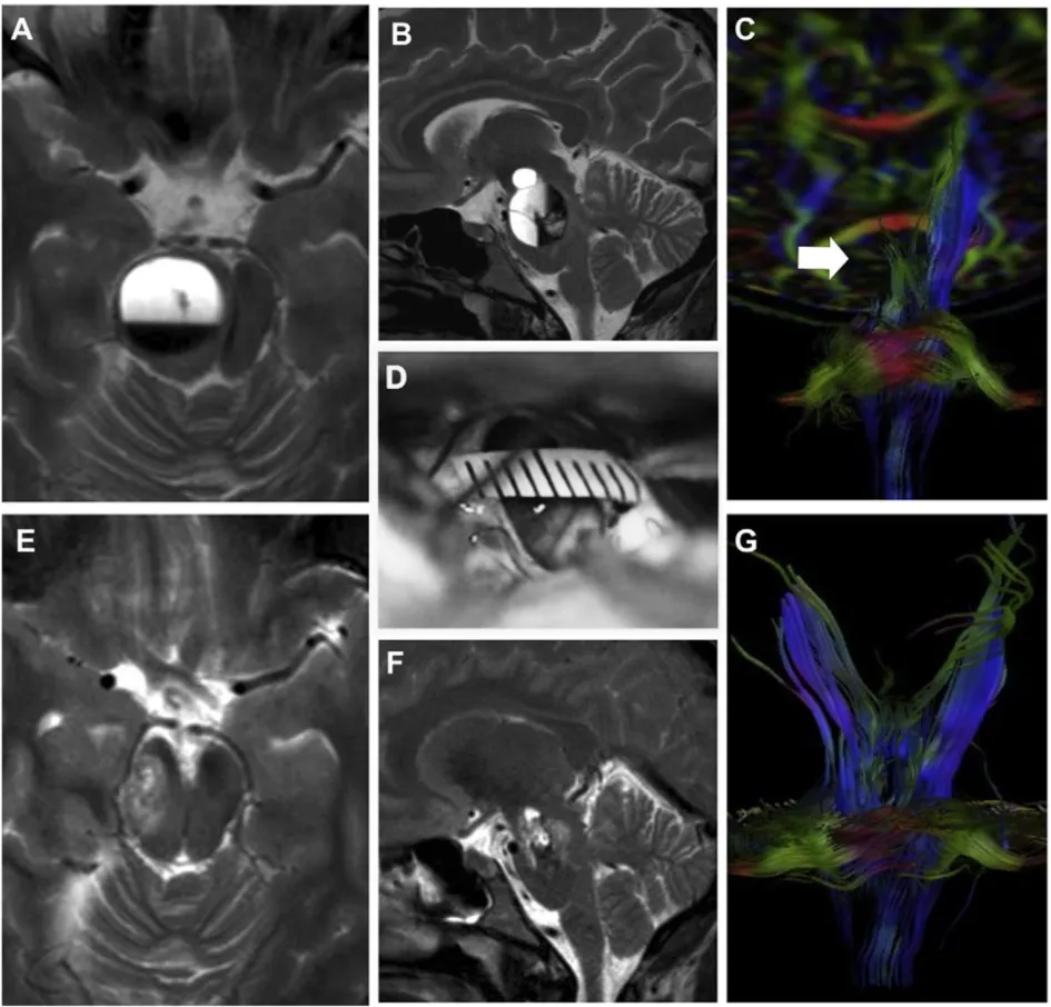 妊娠期术前MRI（A-C）、术中视野（D）及术后MRI（E-G）。