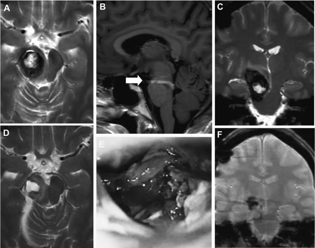 二次手术术前MRI（A-C）、术中显微镜视野（E）、术后MRI（D、F）