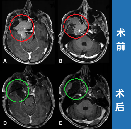 脑膜瘤复发什么症状?读懂大脑发出的这些“求救信号”至关重要
