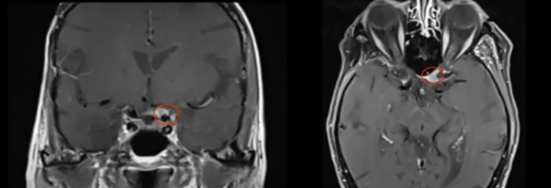 脑膜瘤术后11年复发，首发症状为视力下降