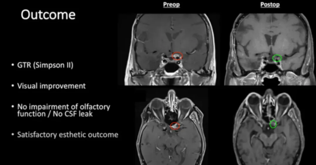 术前及术后磁共振成像。术前preop（A）和术后Postop（C）显示肿瘤完全切除。