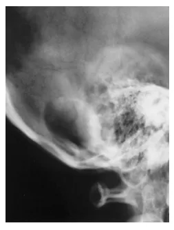图1头颅侧位X线片显示枕下区一溶骨性病变。