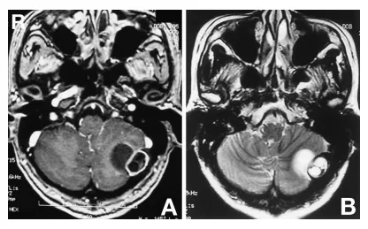 图3A:钆增强T1加权磁共振成像显示一哑铃型肿瘤,由一伴有边缘环形强化的硬膜外部分和一有包膜的硬膜下部分构成。B:T2加权磁共振成像显示板障内部分信号强度不均,小脑内部分呈高信号。