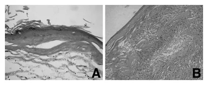 图5,显微照片显示:A硬膜下部分囊壁内衬扁平鳞状上皮,囊腔充满大量角化碎屑;B硬膜外囊壁可见异物巨细胞反应及淋巴细胞浸润。(苏木精-伊红染色,A:×200,B:×20)