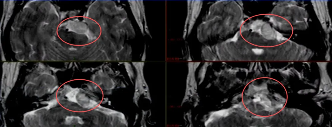 当颅底肿瘤威胁司机的“双眼”，术者如何打赢这场神经守护战？