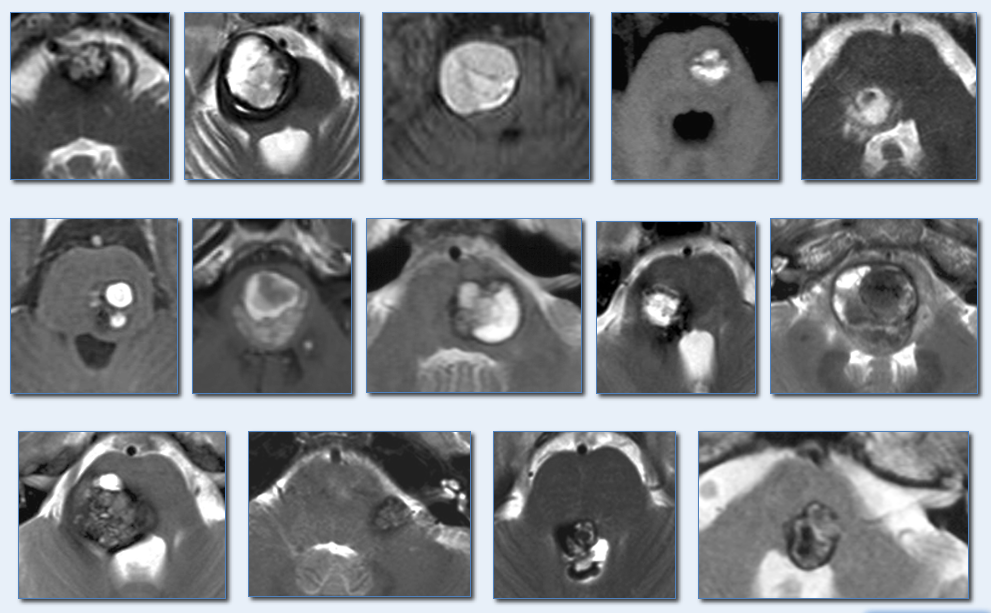 巴教授桥脑海绵状血管瘤案例