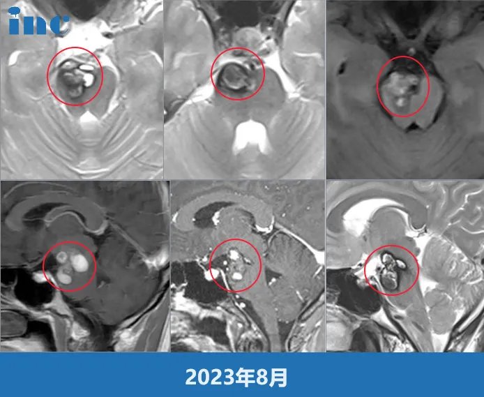 女性脑干海绵状血管瘤患者，怀孕前该先手术吗？