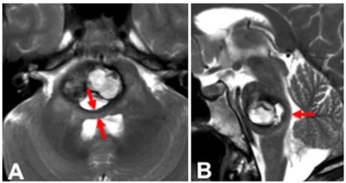 “手术风险大，放疗和药物可以救我吗？”脑干海绵状血管瘤出血怎么办？