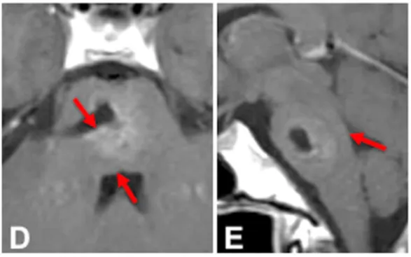 术后影像上记录了切除情况，病灶得到全切（D和E）