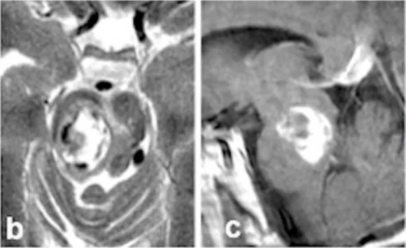 多发脑海绵状血管畸形