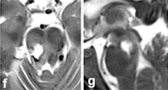 术后影像（图f-g）